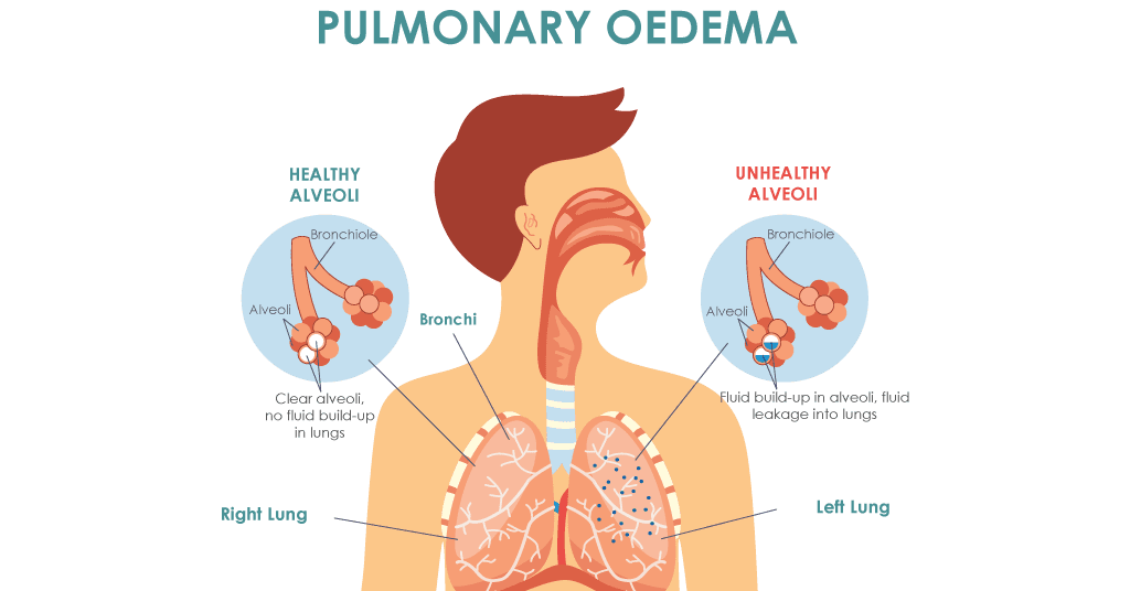 An illustration showing healthy alveoli vs unhealthy alveoli in fluid filled lungs