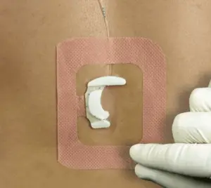 Epi-fix epidural catheter securement device