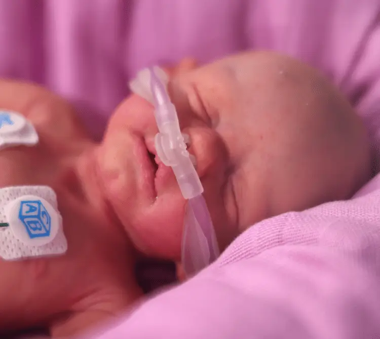 Neonate wearing a nasal cannula receiving High Flow Oxygen Therapy Neonate wearing a nasal cannula receiving High Flow Oxygen Therapy