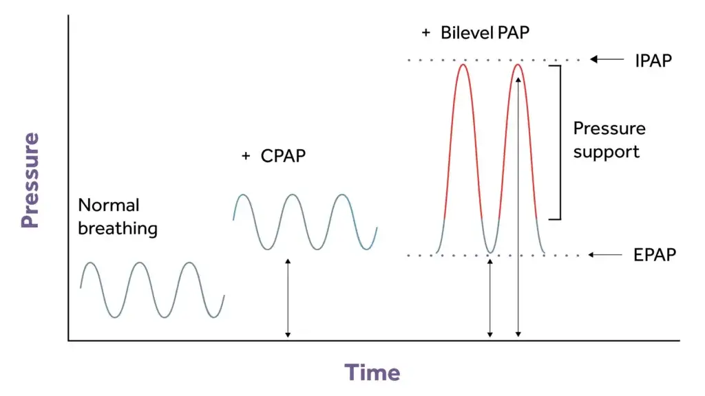 The Differences Between CPAP And Bilevel PAP Inspire Blog
