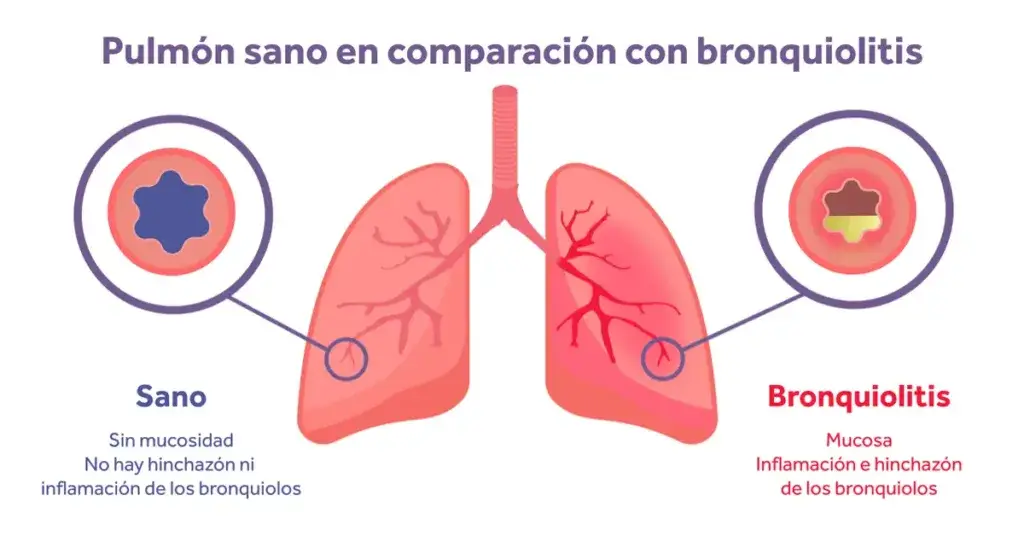 INSPIRE Tratamiento de la bronquiolitis ¿que dice la evidencia Eakin Healthcare