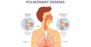 Pulmonary Oedema Diagram Eakin Healthcare